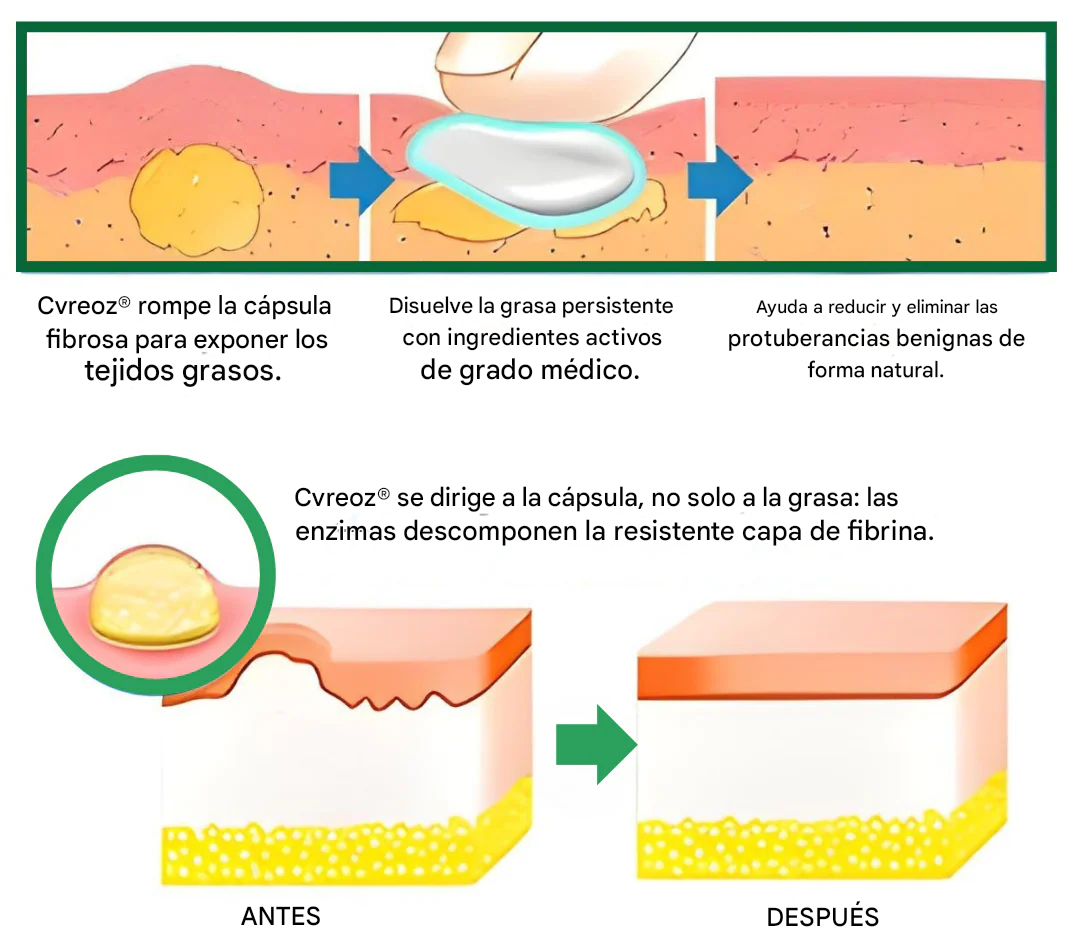 Crema para lipomas Cvreoz® Knot-X