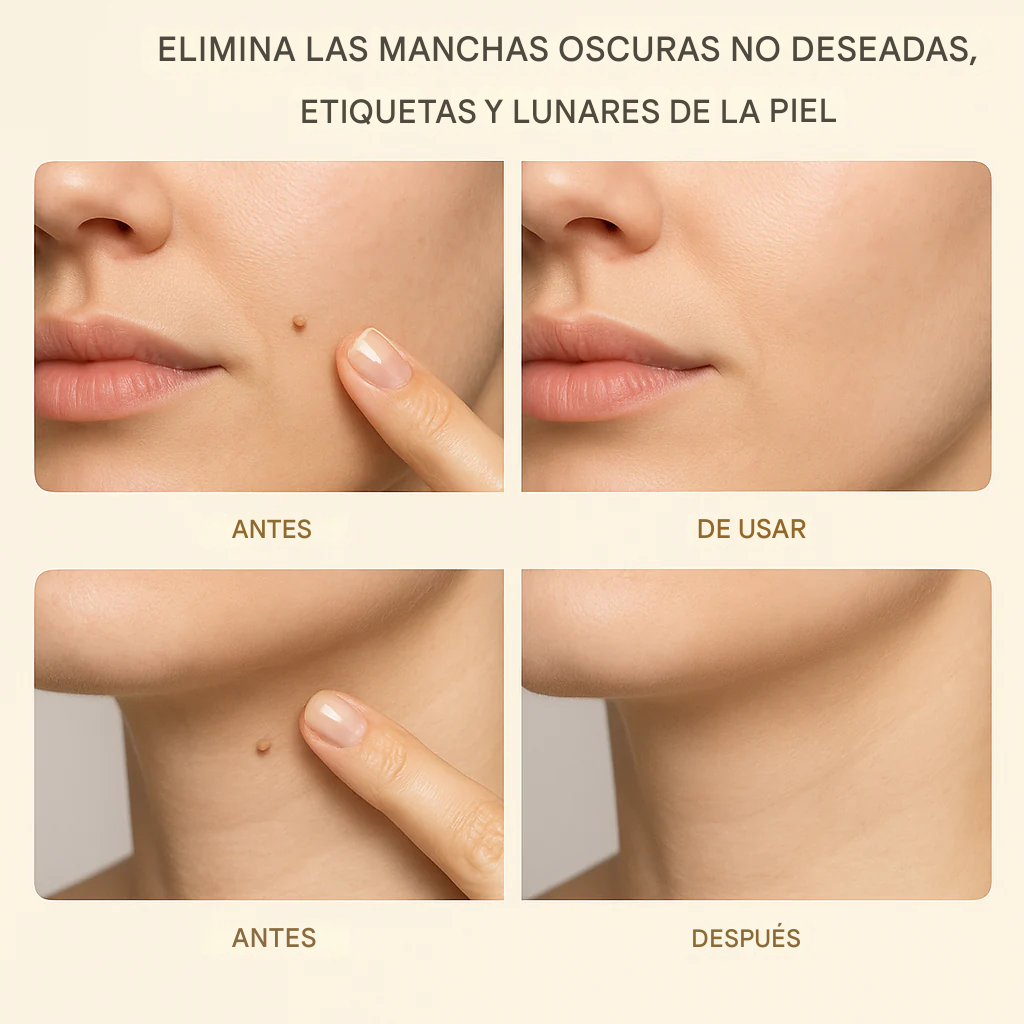 Suero orgánico para eliminar verrugas cutáneas Lanbena™️ | Totalmente natural para las verrugas