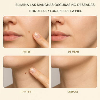 Suero orgánico para eliminar verrugas cutáneas Lanbena™️ | Totalmente natural para las verrugas