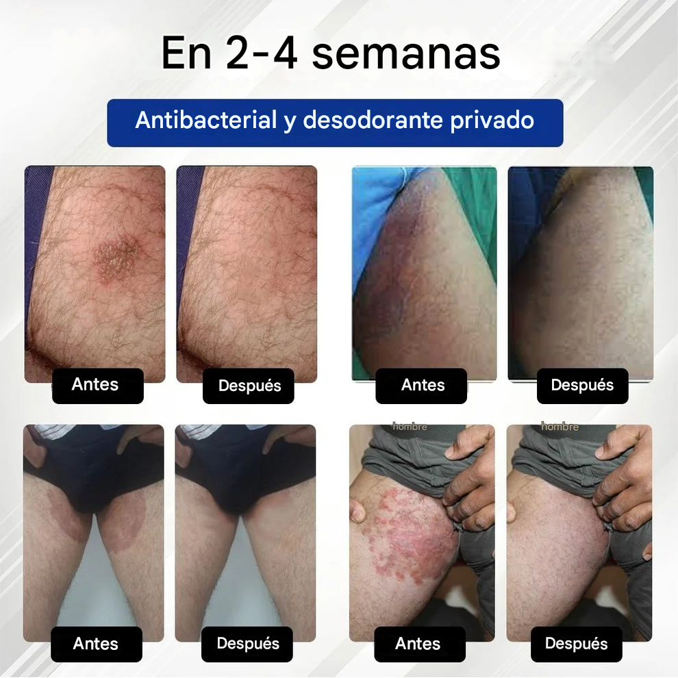 Crema antimicótica genital masculina SEALAYEA® LicorRelief