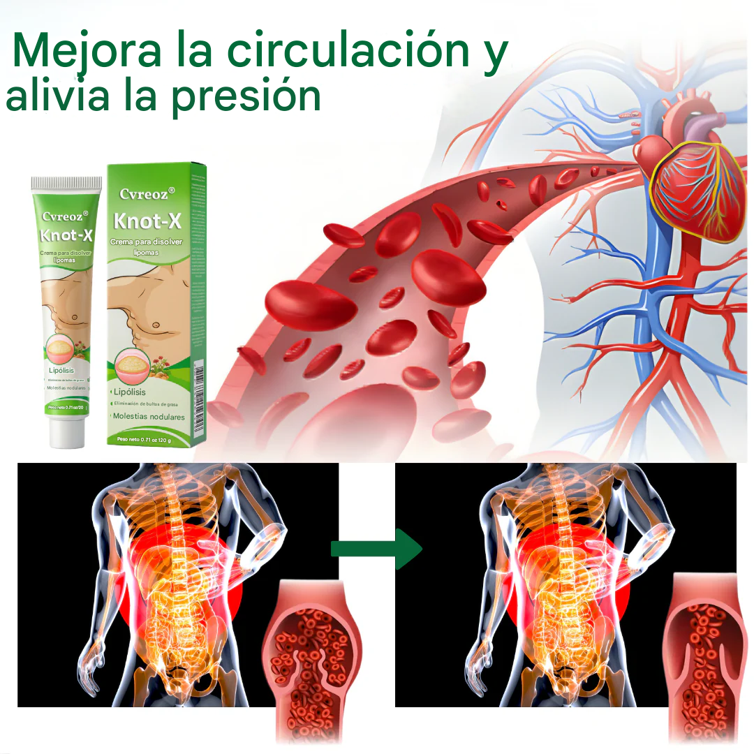 Crema para lipomas Cvreoz® Knot-X