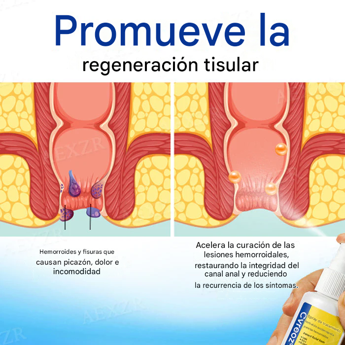 Spray de tratamiento de acción rápida para hemorroides a base de hierbas