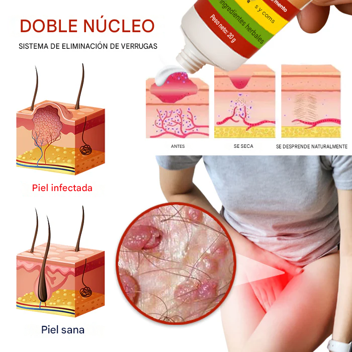 Crema removedora de verrugas genitales femeninas