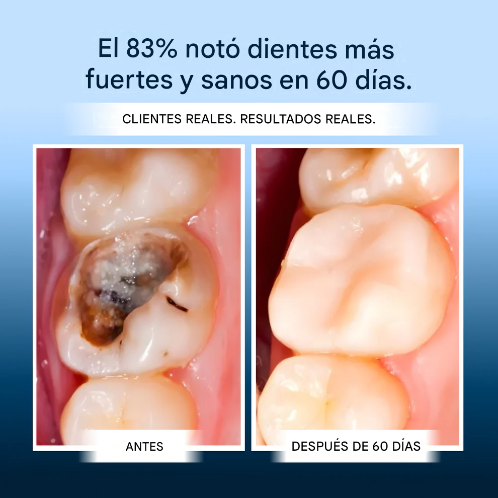 Armadura dental OxyTeeth 🫧🦷