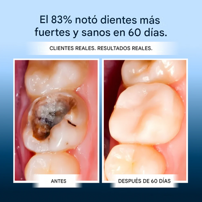 Armadura dental OxyTeeth 🫧🦷