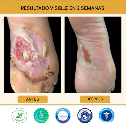 Healrize® Spray curativo para pies diabéticos con veneno de abeja