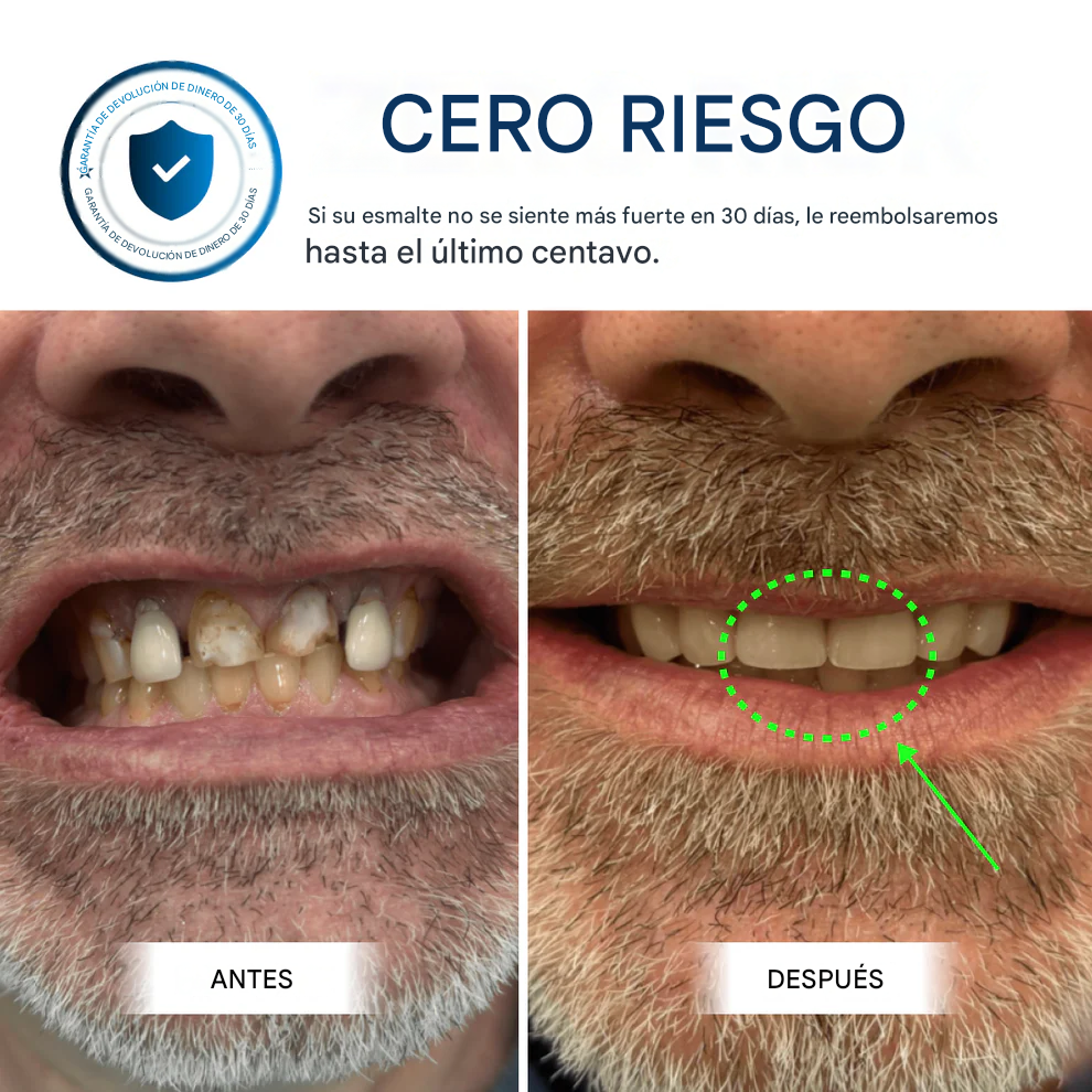 Armadura dental OxyTeeth 🫧🦷