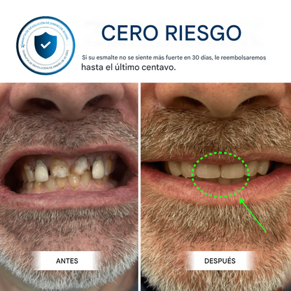 Armadura dental OxyTeeth 🫧🦷
