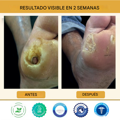 Healrize® Spray curativo para pies diabéticos con veneno de abeja
