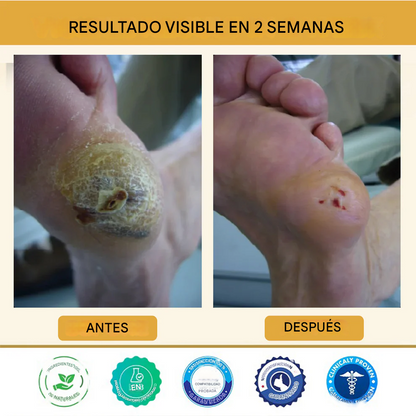 Healrize® Spray curativo para pies diabéticos con veneno de abeja