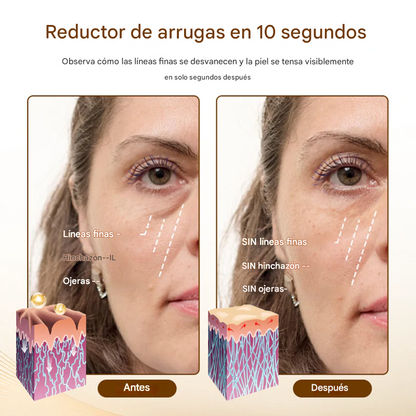 Reductor de arrugas Lovilds® 10s