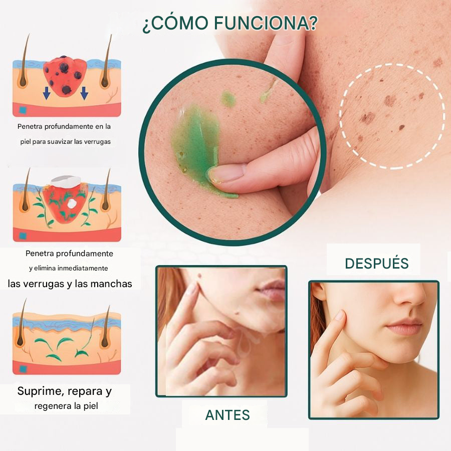 Luxevéria | Clínicamente probado para eliminar el 97% de lunares, verrugas e imperfecciones de la piel — ¡de forma permanente en tan solo 3 días!