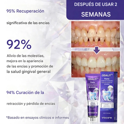 Pasta dental ODALIT™ VioCore con veneno de abeja para tratamiento dental