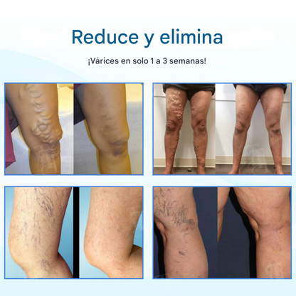 Resultados visibles en 7 días + Atenúa las arañas vasculares rápidamente✨Cvreoz® Spray de tratamiento herbal para venas varicosas