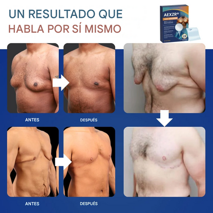 Bioparche con nanoagujas AEXZR® Para ginecomastia, grasa en el pecho, piel flácida, piel suelta y más
