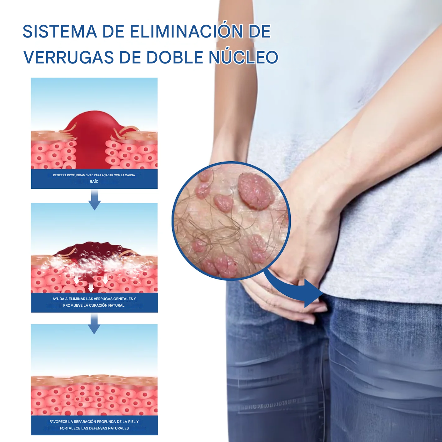 Espuma genital Fivfivgo® Advanced para el alivio del VPH y las erupciones cutáneas.