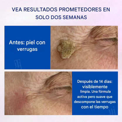 ⏱️ ¡Piel impecable en 48 horas! |  Removedor de verrugas en barra sólida RZXEA™